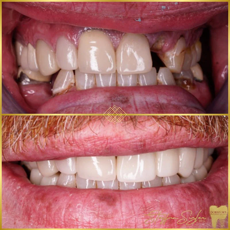 Downtown Dental Implant Patient