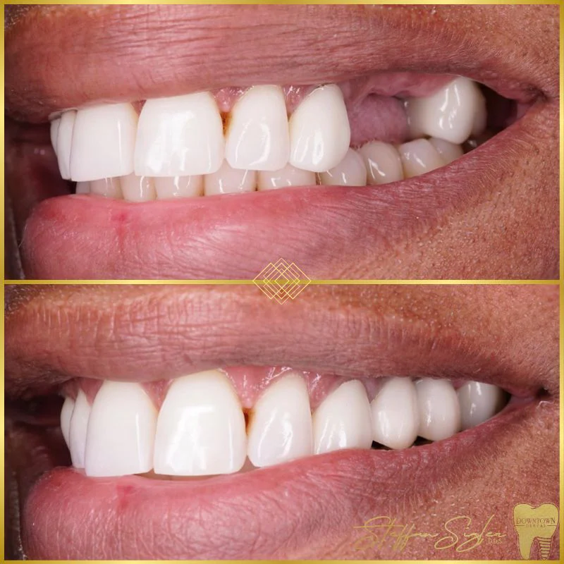 Downtown Dental Patient Transformation Before And After